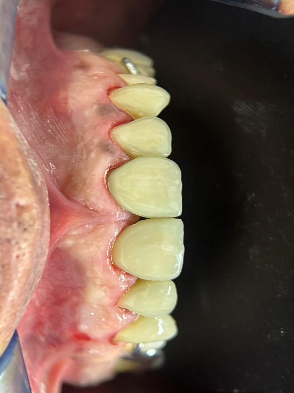 Prueba lateral