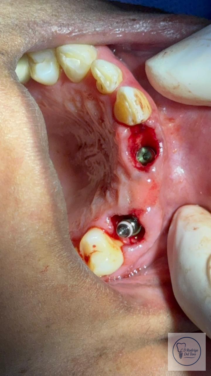 Implantes antes