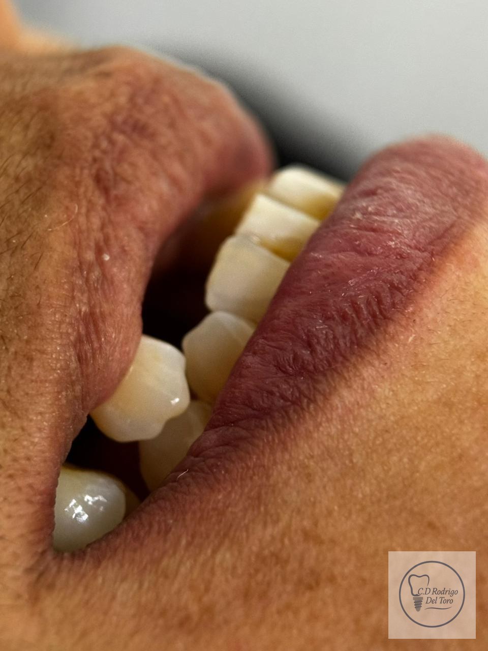 Antes — Prótesis Total