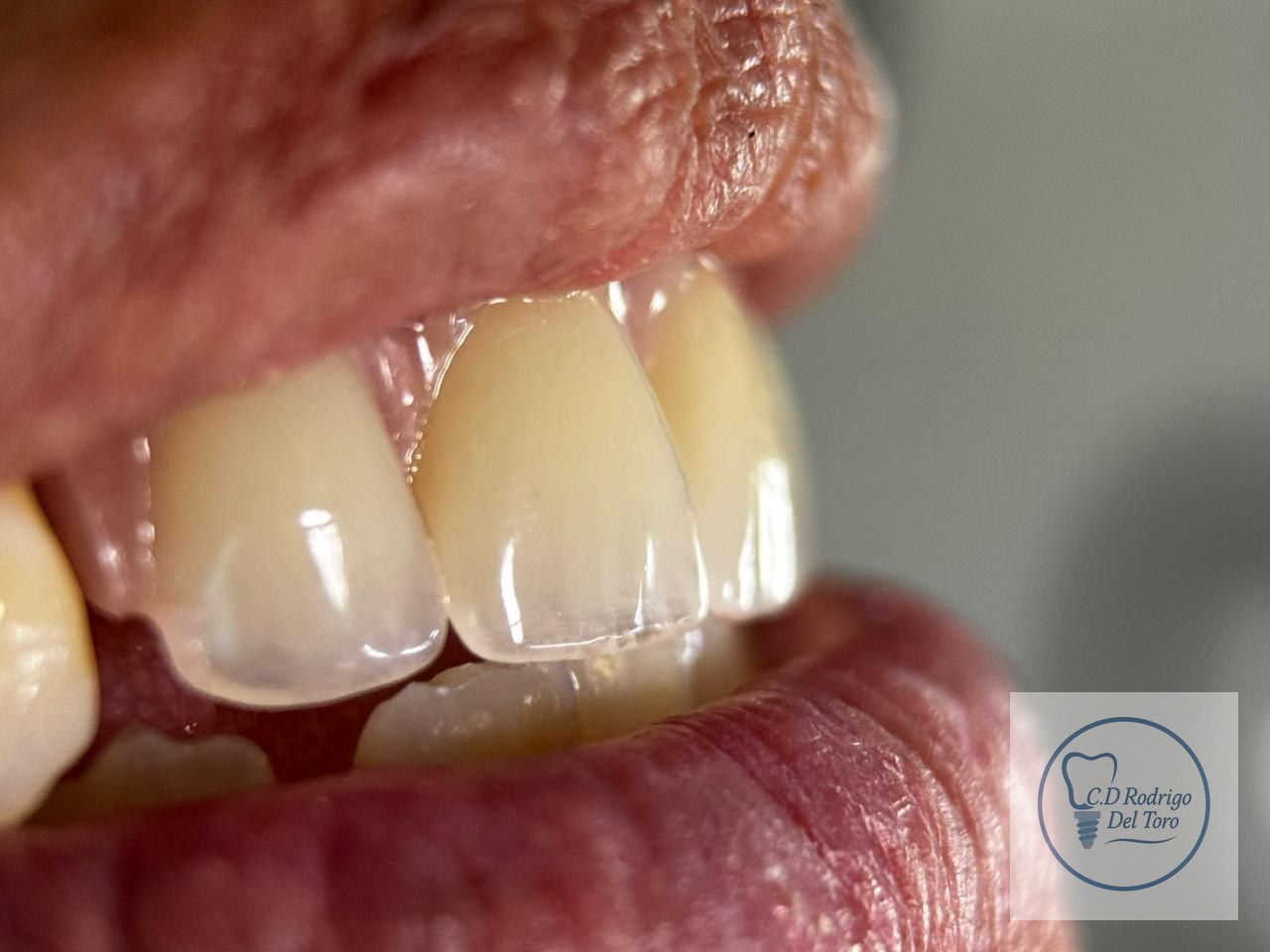 Después — Prótesis Total