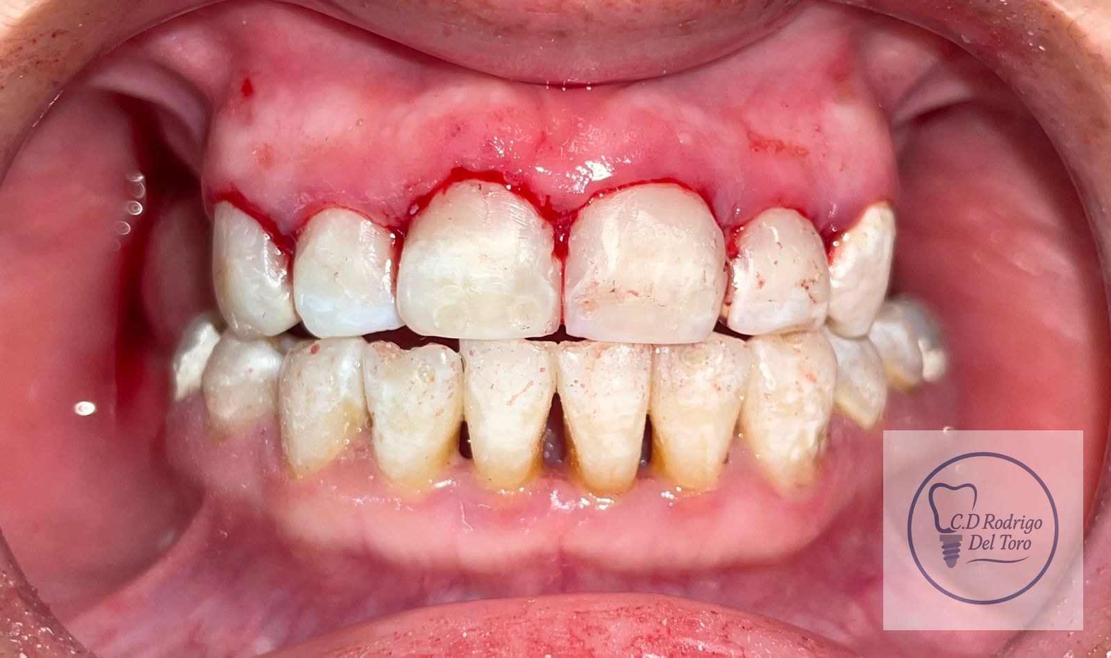 Resinas Encias - Antes