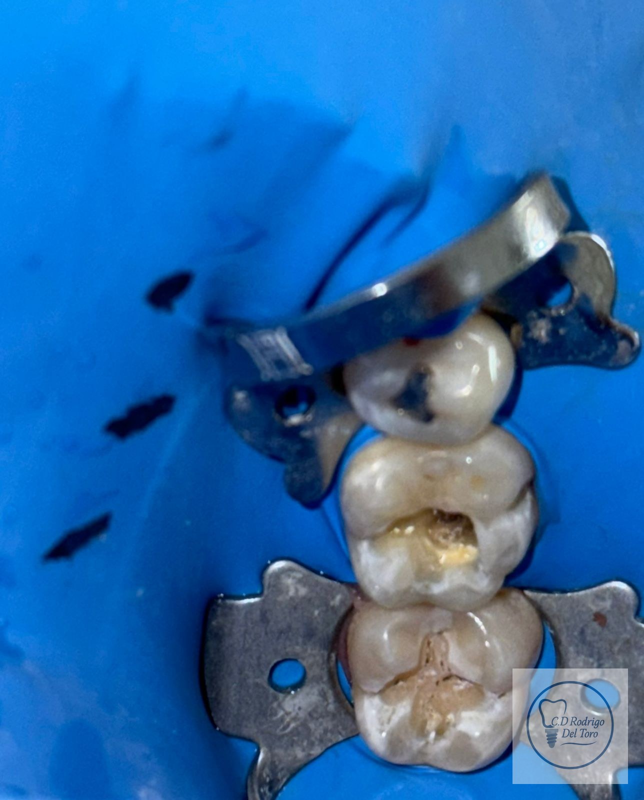 Antes — Resinas Frontales