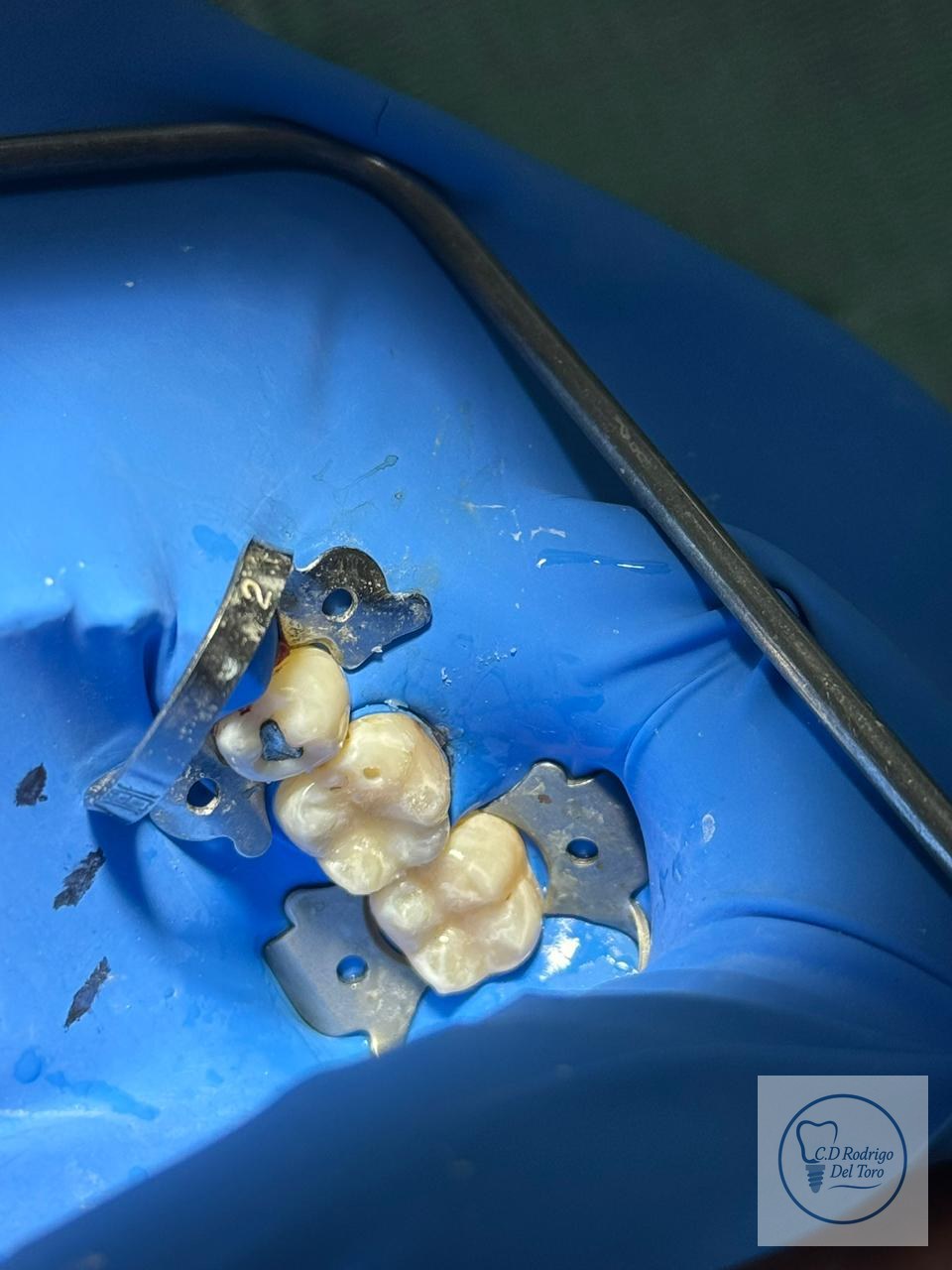 Después — Resinas Frontales